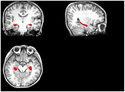 Identifying Epilepsy Based on Deep Learning Using DKI Images